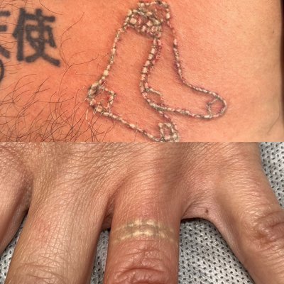 Laser Tattoo Removal - At The Sacred Glo, we specialize in customizing a holistic service that will overall enhance your inner well being and your outer beauty. We are experts in laser tattoo removal, hydrafacials, tattoo removal, microblading eyebrows, microneedling, fibroblast skin rejuvenation and more.
Call us today to get a free consultation! Laser Tattoo Removal - At The Sacred Glo, we specialize in customizing a holistic service that will overall enhance your inner well being and your outer beauty. We are experts in laser tattoo removal, hydrafacials, tattoo removal, microblading eyebrows, microneedling, fibroblast skin rejuvenation and more.
Call us today to get a free consultation!