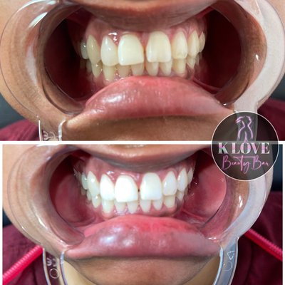 Teeth Whitening - Teeth whitening is a very effective way of lightening the natural color of your teeth without removing any of the tooth surface. It cannot make a complete colour change, but it may lighten the existing shade.