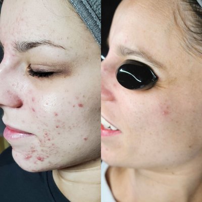 Before and After's of Acne clients - Witness the life-changing results of our Acne Bootcamp and consistent monthly treatments. These before & after photos highlight the incredible dedication of our clients, who achieved these transformations with our recommended products. If you're ready to invest in your skin and see your own amazing before & after, book today!