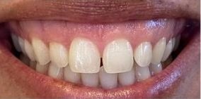 Cosmetic Dentistry - Before / After Cosmetic Dentistry - Before / After