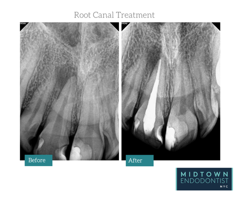 Root Canal treatment (before & after) - These are examples of the Root Canal Treatments completed by root canal specialists working in Midtown Endodontist NYC Root Canal treatment (before & after) - These are examples of the Root Canal Treatments completed by root canal specialists working in Midtown Endodontist NYC