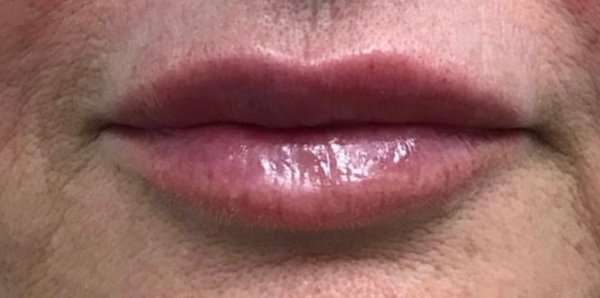 Lip Filler treatment before and after - These lips were treated using Restylane Kysee. This Patients goals were to obtain a natural hydrated look restoring volume. Results look to have given a plumper, hydrated, very natural enhancement. Lip Filler treatment before and after - These lips were treated using Restylane Kysee. This Patients goals were to obtain a natural hydrated look restoring volume. Results look to have given a plumper, hydrated, very natural enhancement.