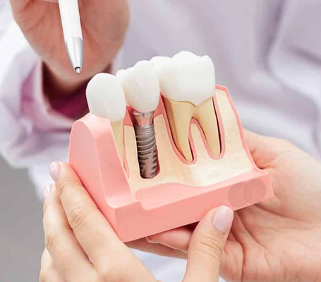 Cosmetic Dentistry - At Avalon Dental Care, we offer a range of cosmetic dentistry services, including the following:
Teeth Whitening: Teeth Whitening is one of the most popular cosmetic dentistry treatments. It is a safe and effective way to brighten your smile and boost your confidence. At Avalon Dental Care, we offer both in-office and at-home teeth whitening options. Our in-office Boost Teeth Whitening system can brighten your smile by several shades in a single appointment, while our Opalescence home whitening kits offer a gradual approach to a whiter smile from the comfort of your home.
Cosmetic Bonding: Cosmetic bonding offers a quick and cost-effective solution to repair minor discoloration, chips, cracks, or gaps, enhancing your smile. The procedure involves applying a small amount of tooth-colored composite resin material to the affected tooth's surfaces and skillfully and artistically sculpting it to the shape of your natural teeth. Next, we will harden the resin for a natural-looking and durable finish. Cosmetic bonding will leave you with a flawless smile in just one office visit!
Tooth-Colored Fillings: Tooth-colored fillings offer a discreet and durable solution for repairing cavities or replacing old metal fillings. They are made from a composite resin material that closely matches your natural teeth, restoring the health, aesthetics, and function of your smile.
Porcelain Veneers: Porcelain veneers are ultra-thin, custom-made shells that cover the front surfaces of your teeth. They are ideal for addressing a range of concerns, like discolored, chipped, gapped, worn, misshapen, or misaligned teeth. The porcelain material is highly durable and mimics the translucency of your natural teeth, delivering a stunning and long-lasting smile.
Dental Implants: Implant dentistry is today's gold standard for replacing missing teeth, delivering results second only to natural, healthy teeth. The procedure involves placing a titanium implant, which fuses with your jawbone as the area heals, providing a solid foundation for your replacement teeth. At Avalon Dental Care, we offer single implant crowns, implant-supported bridges, implant-supported dentures, and All-on-4s. Whether you’re missing one, several, or all of your teeth, we have the perfect solution for you.
Dental Crowns and Bridges: At Avalon Dental Care, we offer dental crowns to cover damaged teeth, restoring their form and function. These aesthetic restorations can also improve the color, size, shape, length, and alignment of teeth, enhancing the appearance and function of your smile. A dental bridge, on the other hand, "bridges" the gap left by one or more neighboring teeth, restoring your complete smile.
Dentures: If you are missing several or all of your teeth, a complete or partial denture offers a time-tested solution to restore your smile's health and function. Today's modern dentures are more comfortable and natural-looking than ever before, enhancing your smile and quality of life. Cosmetic Dentistry - At Avalon Dental Care, we offer a range of cosmetic dentistry services, including the following:
Teeth Whitening: Teeth Whitening is one of the most popular cosmetic dentistry treatments. It is a safe and effective way to brighten your smile and boost your confidence. At Avalon Dental Care, we offer both in-office and at-home teeth whitening options. Our in-office Boost Teeth Whitening system can brighten your smile by several shades in a single appointment, while our Opalescence home whitening kits offer a gradual approach to a whiter smile from the comfort of your home.
Cosmetic Bonding: Cosmetic bonding offers a quick and cost-effective solution to repair minor discoloration, chips, cracks, or gaps, enhancing your smile. The procedure involves applying a small amount of tooth-colored composite resin material to the affected tooth's surfaces and skillfully and artistically sculpting it to the shape of your natural teeth. Next, we will harden the resin for a natural-looking and durable finish. Cosmetic bonding will leave you with a flawless smile in just one office visit!
Tooth-Colored Fillings: Tooth-colored fillings offer a discreet and durable solution for repairing cavities or replacing old metal fillings. They are made from a composite resin material that closely matches your natural teeth, restoring the health, aesthetics, and function of your smile.
Porcelain Veneers: Porcelain veneers are ultra-thin, custom-made shells that cover the front surfaces of your teeth. They are ideal for addressing a range of concerns, like discolored, chipped, gapped, worn, misshapen, or misaligned teeth. The porcelain material is highly durable and mimics the translucency of your natural teeth, delivering a stunning and long-lasting smile.
Dental Implants: Implant dentistry is today's gold standard for replacing missing teeth, delivering results second only to natural, healthy teeth. The procedure involves placing a titanium implant, which fuses with your jawbone as the area heals, providing a solid foundation for your replacement teeth. At Avalon Dental Care, we offer single implant crowns, implant-supported bridges, implant-supported dentures, and All-on-4s. Whether you’re missing one, several, or all of your teeth, we have the perfect solution for you.
Dental Crowns and Bridges: At Avalon Dental Care, we offer dental crowns to cover damaged teeth, restoring their form and function. These aesthetic restorations can also improve the color, size, shape, length, and alignment of teeth, enhancing the appearance and function of your smile. A dental bridge, on the other hand, "bridges" the gap left by one or more neighboring teeth, restoring your complete smile.
Dentures: If you are missing several or all of your teeth, a complete or partial denture offers a time-tested solution to restore your smile's health and function. Today's modern dentures are more comfortable and natural-looking than ever before, enhancing your smile and quality of life.