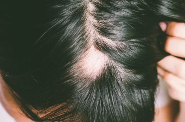 Alopecia Areata - Alopecia areata, or spot baldness, is a condition where hair is lost from certain areas of the body in patchy patterns. We can discuss the causes of this problem and perform any necessary tests. This condition can usually be successfully treated with various interventions, including organic vitamin supplements, intralesional steroid injections, as well as topical medications. Call us at 703-705-7000 or go to www.clinicaldermatologycenter.com to schedule an appointment!