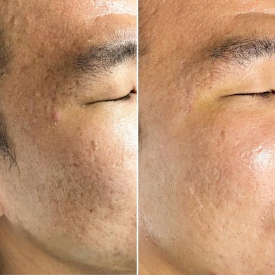 Scar Treatments - We use a variety of advanced treatments to combat acne scars, including microneedling, lasers, TCA cross, subcision, PRP, Ultra Laser, BBL/Halo, Hollywood Spectra fractional MLA, and Genius RF Microneedling. Scar Treatments - We use a variety of advanced treatments to combat acne scars, including microneedling, lasers, TCA cross, subcision, PRP, Ultra Laser, BBL/Halo, Hollywood Spectra fractional MLA, and Genius RF Microneedling.