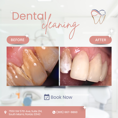 🦷✨ Before & After at ALSMILE - Laser Cleaning is a modern, non-invasive treatment that targets bacteria below the gumline — without pain or surgery.
-Reduces inflammation
-Helps treat periodontal disease
- Promotes gum healing
- Safe, fast, and effective
Book your FREE evaluation at ALSMILE and start your journey to healthier gums today! 🦷✨ Before & After at ALSMILE - Laser Cleaning is a modern, non-invasive treatment that targets bacteria below the gumline — without pain or surgery.
-Reduces inflammation
-Helps treat periodontal disease
- Promotes gum healing
- Safe, fast, and effective
Book your FREE evaluation at ALSMILE and start your journey to healthier gums today!