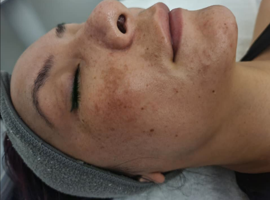 Brightening Treatment - Brightening Treatment Brightening Treatment - Brightening Treatment