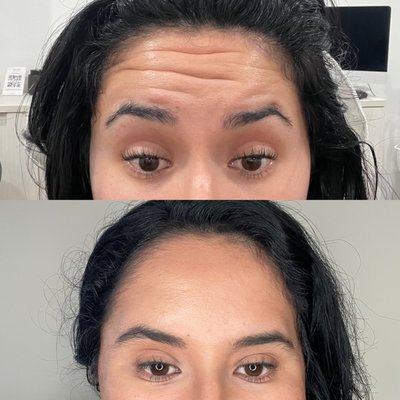 BEFORE & AFTERS - Need a smooth forehead less wrinkles ? Try out our wrinkle relaxers ! Who doesn’t love clear skin with medical grade facial Diamond glow BEFORE & AFTERS - Need a smooth forehead less wrinkles ? Try out our wrinkle relaxers ! Who doesn’t love clear skin with medical grade facial Diamond glow