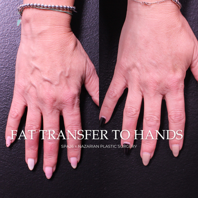 Fat Transfer To Hands: Before & After - Fat transfer is the surgical process of transferring fat from a fat-abundant donor area, purifying it, and inserting it into the target area for a more youthful appearance. It is a minimally invasive technique that utilizes the excess fat on any body area—typically the abdomen or thighs. This fat is tranferred to the treatment area to naturally restore the volume to virtually any body area, including the breasts, face, or...

Fat transfer is a highly effective and safe technique for breast augmentation, facial fat grafting, and lip augmentation because it is yours. Your body cannot react to or refuse it; you cannot have any allergic reaction to it. Fat transfer results gradually develop over six months, with optimal results lasting a lifetime.

Plastic surgeon near me
Fat transfer in LA
Fat transfer in Beverly Hills
Plastic surgeons that offer financing
Women Plastic Surgeon
Plastic Surgeon in Beverly Hills
Netflix Surgeon
Women Owned