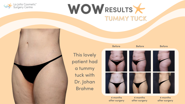 Tummy Tuck - Whether you want a flatter tummy or to ditch the muffin top, tummy tuck can target excess skin and stretched muscles to give you a firm and sculpted midsection. Here are before and after photos of abdominoplasty results by the board-certified plastic surgeons at La Jolla Cosmetic Surgery Centre in La Jolla, CA. Tummy Tuck - Whether you want a flatter tummy or to ditch the muffin top, tummy tuck can target excess skin and stretched muscles to give you a firm and sculpted midsection. Here are before and after photos of abdominoplasty results by the board-certified plastic surgeons at La Jolla Cosmetic Surgery Centre in La Jolla, CA.