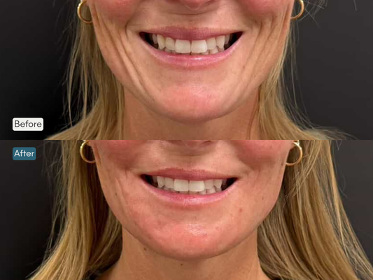 Regenerative Treatments - Harness the power of regenerative aesthetics with advanced treatments like Sculptra®, Radiesse®, Renuva®, and Salmon DNA (PDRN). Stimulate collagen, restore volume, and rejuvenate skin quality from within. Regenerative Treatments - Harness the power of regenerative aesthetics with advanced treatments like Sculptra®, Radiesse®, Renuva®, and Salmon DNA (PDRN). Stimulate collagen, restore volume, and rejuvenate skin quality from within.