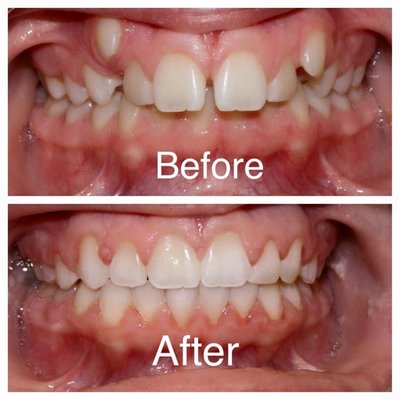 Before & After - Check out some of the amazing smiles we've been able to help create.