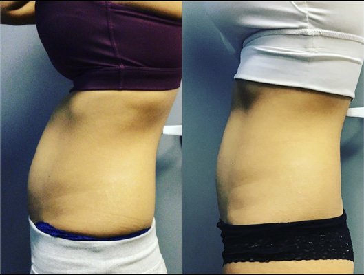 Pigment reduction, skin rejuvenation and body contouring. - For pigment reduction and skin rejuvenation 2-3 treatments needed spaced out 2 weeks to 1 month apart. Body contouring with Vanquish ME requires 4 treatments spaced out 10-14 days apart to archive 1-3 inches reduction in circumference. Pigment reduction, skin rejuvenation and body contouring. - For pigment reduction and skin rejuvenation 2-3 treatments needed spaced out 2 weeks to 1 month apart. Body contouring with Vanquish ME requires 4 treatments spaced out 10-14 days apart to archive 1-3 inches reduction in circumference.