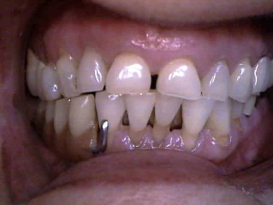 From dentures to Implants - A patient with a mature edentulous lower right, and failing lower anterior teeth, is upgraded from a partial to implants From dentures to Implants - A patient with a mature edentulous lower right, and failing lower anterior teeth, is upgraded from a partial to implants