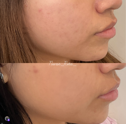 Aerolase NEO and ERA Laser Treatments - Safely treats 36+ FDA approved skin conditions including:
Acne & Acne scars
Melasma
Rosacea
Skin laxity, boosts collagen production
Skin tone and texture
Hyperpigmentation (sunspots)
Eczema
Psoriasis
Stretch marks
Wrinkles & fine lines
Spider veins
Skin tags and more... Aerolase NEO and ERA Laser Treatments - Safely treats 36+ FDA approved skin conditions including:
Acne & Acne scars
Melasma
Rosacea
Skin laxity, boosts collagen production
Skin tone and texture
Hyperpigmentation (sunspots)
Eczema
Psoriasis
Stretch marks
Wrinkles & fine lines
Spider veins
Skin tags and more...