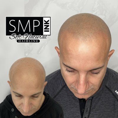 Scalp Micropigmentation soft natural hairlines - We specialize in natural soft hair lines. Every client has a different vision and would like a different style hairline but then naturally soft hairline is the hardest to replicate but he have it down! Scalp Micropigmentation soft natural hairlines - We specialize in natural soft hair lines. Every client has a different vision and would like a different style hairline but then naturally soft hairline is the hardest to replicate but he have it down!