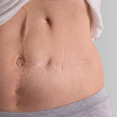 Scar Tissue & Fibrosis Treatment - Our scar tissue treatment is uniquely crafted to reduce scar tissue and enhance healing. Our team is thoroughly trained in the nuances of inflammatory stages, focusing initially on managing inflammation during the acute phase. We begin our specialized treatment only after this critical period, prioritizing safety and maximizing effectiveness. This careful approach ensures a faster, more comfortable recovery. It’s no wonder that over 25 doctors in Houston exclusively trust our clinic with their patients’ care.
What Is Fibrosis And How Do We Treat It?
Fibrosis after surgery is a condition where excess fibroblast cells in the body create tough tissue, leading to hardness under the skin. This occurs as part of the healing process, with fibroblasts being crucial for collagen disposition. Fibrosis can cause discomfort and cosmetic concerns, such as lumps, large pores, tissue discolorations, and uneven skin areas. Scar Tissue & Fibrosis Treatment - Our scar tissue treatment is uniquely crafted to reduce scar tissue and enhance healing. Our team is thoroughly trained in the nuances of inflammatory stages, focusing initially on managing inflammation during the acute phase. We begin our specialized treatment only after this critical period, prioritizing safety and maximizing effectiveness. This careful approach ensures a faster, more comfortable recovery. It’s no wonder that over 25 doctors in Houston exclusively trust our clinic with their patients’ care.
What Is Fibrosis And How Do We Treat It?
Fibrosis after surgery is a condition where excess fibroblast cells in the body create tough tissue, leading to hardness under the skin. This occurs as part of the healing process, with fibroblasts being crucial for collagen disposition. Fibrosis can cause discomfort and cosmetic concerns, such as lumps, large pores, tissue discolorations, and uneven skin areas.