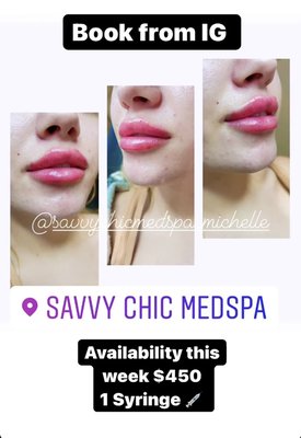 Savvydoll lips by and of our amazing injectors! Michelle, Dana, Kylee, and Aly. - Savvy Chic loves tailor made services to fit your needs and budget! Let us help you meet your skin care goals for 2022. Savvydoll lips by and of our amazing injectors! Michelle, Dana, Kylee, and Aly. - Savvy Chic loves tailor made services to fit your needs and budget! Let us help you meet your skin care goals for 2022.
