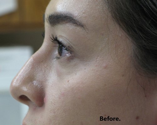 Non-surgical rhinoplasty with filler. - Non-surgical rhinoplasty is an intricate procedure that can change the appearance of a nose. Filler is placed in stategic locations to act as graft material to provide support. Knowledge of anatomy is a key since vessels in the nose are intricately connected to the central retinal artery where intravascular injections will cause severe complications. Above are examples of non-surgical rhinoplasty patients that had dorsal humps, down turned tips and missing cartlidge. The nasal width can also be narrowed. Non-surgical rhinoplasty with filler. - Non-surgical rhinoplasty is an intricate procedure that can change the appearance of a nose. Filler is placed in stategic locations to act as graft material to provide support. Knowledge of anatomy is a key since vessels in the nose are intricately connected to the central retinal artery where intravascular injections will cause severe complications. Above are examples of non-surgical rhinoplasty patients that had dorsal humps, down turned tips and missing cartlidge. The nasal width can also be narrowed.