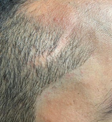 Scalp Micropigmentation - Scar Camouflage - With the help of SMP this clients scar has disappeared leaving a perfect hairline. Scalp Micropigmentation - Scar Camouflage - With the help of SMP this clients scar has disappeared leaving a perfect hairline.