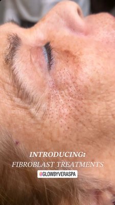 Fibroblasts - Fibroblast skin tightening is a non-invasive procedure that uses a plasma arc to trigger the body's natural healing process and promote the regeneration of healthy skin cells. This results in tighter, smoother, and more youthful-looking skin, making it ideal for reducing the appearance of fine lines, wrinkles, and sagging skin. *Not recommended for darker skin types.
Book a consultation to see if this treatment is right for you.* Fibroblasts - Fibroblast skin tightening is a non-invasive procedure that uses a plasma arc to trigger the body's natural healing process and promote the regeneration of healthy skin cells. This results in tighter, smoother, and more youthful-looking skin, making it ideal for reducing the appearance of fine lines, wrinkles, and sagging skin. *Not recommended for darker skin types.
Book a consultation to see if this treatment is right for you.*