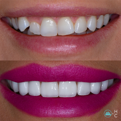 Veneers - We offer Hoffman Cosmetics, Dr. Nathan Hoffman’s exclusive brand for cosmetic dentistry. Hoffman Cosmetics ceramic veneers are completely customized to each smile using an extremely conservative prep technique. The material used to craft the veneers offers a high aesthetic potential with a translucent appearance, allowing light to pass through them, just as natural teeth do. The minimal prep technique in conjunction with the high-grade material, results in veneers that look alive and offer a perfectly natural appearance. Veneers - We offer Hoffman Cosmetics, Dr. Nathan Hoffman’s exclusive brand for cosmetic dentistry. Hoffman Cosmetics ceramic veneers are completely customized to each smile using an extremely conservative prep technique. The material used to craft the veneers offers a high aesthetic potential with a translucent appearance, allowing light to pass through them, just as natural teeth do. The minimal prep technique in conjunction with the high-grade material, results in veneers that look alive and offer a perfectly natural appearance.