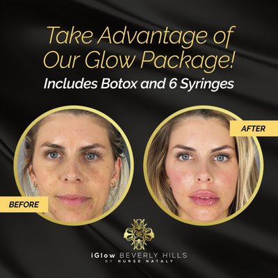 Botox - BOTOX® Cosmetic is a nonsurgical, anti-aging treatment that is injected directly into the muscles, usually between the brows to smooth out fine lines and wrinkles. Botox is also used clinically to treat crows feet area around the eyes. When expertly administered, Botox and other proven neuromodulators such as Dysport offer an effective solution for wrinkles, fine lines, and other signs of aging, while also being minimally invasive, highly effective. This makes BOTOX an affordable alternative to cosmetic surgery such as a brow lift or face lift and other surgical procedures that require surgeons, anesthesia, scalpels, stitches, and lengthy recovery times.
