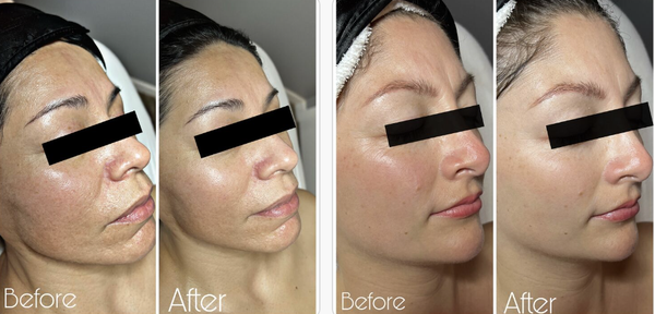 Peptide Face Masks - This firming and tightening mask combines some of the latest technology in peptide, antioxidant and dermal regeneration science, resulting in micro circulation, detoxification and instant firming, lifting and tightening.

Skin Type Indications :
Advanced signs of age, dull, sagging and UV damage