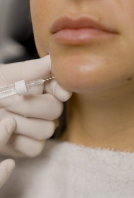 Chin Filler - Chin dermal filler is a treatment that involves injecting into the chin area to enhance and augment the shape and contour of the chin. The dermal filler used in this treatment is typically made of hyaluronic acid, which is a natural component of the skin that helps to hydrate and plump the skin. When injected into the chin, the dermal filler adds volume and definition, creating a more prominent and sculpted chin appearance. Chin Filler - Chin dermal filler is a treatment that involves injecting into the chin area to enhance and augment the shape and contour of the chin. The dermal filler used in this treatment is typically made of hyaluronic acid, which is a natural component of the skin that helps to hydrate and plump the skin. When injected into the chin, the dermal filler adds volume and definition, creating a more prominent and sculpted chin appearance.