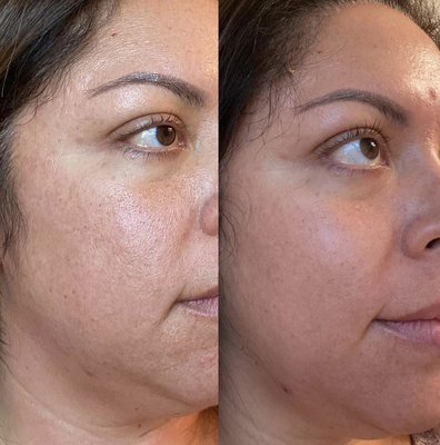Before and after Facials and Chemical Peels - Each facial is completely customizable for you and your skin care needs and goals. No facial is the same, because no skin is the same. I’m here to help you reach your skincare goals through a professional homecare routine, healthy lifestyle and consistent facial treatments.