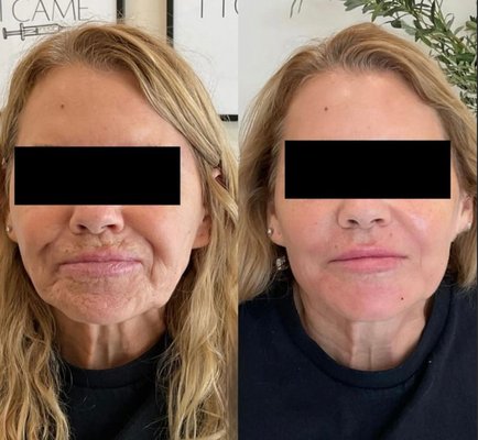 Injectables - Experience the art and precision of aesthetics with our expertly delivered injectable treatments. We offer a range of advanced solutions including Sculptra, dermal fillers, and neuromodulators (tox treatments), all designed to enhance your natural beauty without looking overdone.
Led by our Master Nurse Injector, each treatment is approached with a deep understanding of facial anatomy, symmetry, and aesthetic balance. With a refined eye for detail and artistry, she tailors every procedure to highlight your unique features; restoring volume, smoothing lines, and enhancing contours for subtle, yet transformative results.
Whether you're looking to refresh your appearance or maintain a youthful glow, our injectable treatments deliver natural-looking, long-lasting results in the hands of a trusted expert.
Book your consultation today, We are located in Chatsworth, Los Angeles, CA 91311 Injectables - Experience the art and precision of aesthetics with our expertly delivered injectable treatments. We offer a range of advanced solutions including Sculptra, dermal fillers, and neuromodulators (tox treatments), all designed to enhance your natural beauty without looking overdone.
Led by our Master Nurse Injector, each treatment is approached with a deep understanding of facial anatomy, symmetry, and aesthetic balance. With a refined eye for detail and artistry, she tailors every procedure to highlight your unique features; restoring volume, smoothing lines, and enhancing contours for subtle, yet transformative results.
Whether you're looking to refresh your appearance or maintain a youthful glow, our injectable treatments deliver natural-looking, long-lasting results in the hands of a trusted expert.
Book your consultation today, We are located in Chatsworth, Los Angeles, CA 91311