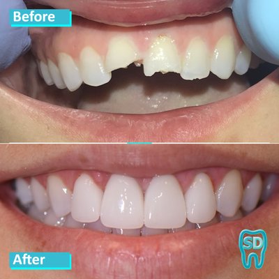 Cosmetic Dentistry | Invisalign, Veneers, Crowns, Teeth Whitening - Our team of smile design experts are passionate about helping patients achieve smiles that promote health, beauty and confidence! Book your complimentary in smile design consultation today! Cosmetic Dentistry | Invisalign, Veneers, Crowns, Teeth Whitening - Our team of smile design experts are passionate about helping patients achieve smiles that promote health, beauty and confidence! Book your complimentary in smile design consultation today!