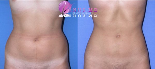 Liposuction in Huntington Beach, CA - Awake liposuction in Huntington Beach comfortably without risky general anesthesia in one session with minimal downtime, great result, fast recovery. Liposuction in Huntington Beach, CA - Awake liposuction in Huntington Beach comfortably without risky general anesthesia in one session with minimal downtime, great result, fast recovery.