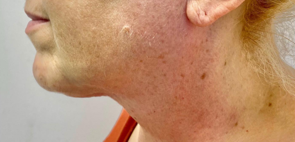 Skin Tightening - Make it Right -> Get it Tight! RF Skin Tightening is a comfortable way to Tone and Tighten your Skin. It smooths and recontours, improving your skin firmness and texture. This is a painless treatment, with great benefits. Contact us for your free consultation.