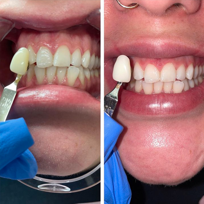 Brighten Your Smile - We offer an affordable solution to otherwise costly teeth whitening services. Our results typically last from 6-12 months. We encourage our clients to keep up regular dental hygiene (brushing and flossing) for the most lasting results after treatment. As a new business we are dedicated to making sure you are satisfied and guarantee results! Brighten Your Smile - We offer an affordable solution to otherwise costly teeth whitening services. Our results typically last from 6-12 months. We encourage our clients to keep up regular dental hygiene (brushing and flossing) for the most lasting results after treatment. As a new business we are dedicated to making sure you are satisfied and guarantee results!