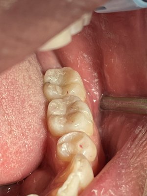 Holistic dental fillings and cosmetic filling covered by most insurances - This is covered by insurances to improve your overall health and smile success Holistic dental fillings and cosmetic filling covered by most insurances - This is covered by insurances to improve your overall health and smile success