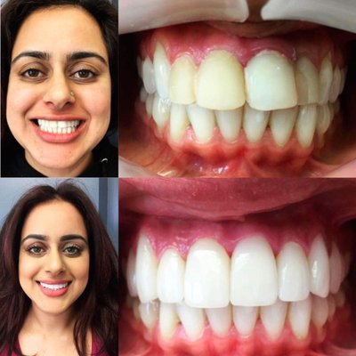 Veneers - A conservative procedure usually requiring minimal anesthesia, veneers are an excellent option to improve the appearance of front teeth. These extremely thin shells of either composite resin filling material, or the more durable ceramic (porcelain), are bonded to the teeth.

Whether enhancing tooth color or shape, masking discolorations, closing moderate spaces, or straightening out minor crowding, veneers can be an excellent alternative to full crowns to create pleasing and esthetic smiles.  They have the added advantage of requiring less tooth preparation than full crowns.

Cases involving front teeth with deep staining (eg. discoloration of teeth due to exposure to the antibiotic tetracycline- in utero or in infancy), older discolored fillings, damage due to injury or wear, or unattractive gaps or minor crowding of front teeth may only require a few appointments to achieve pleasing cosmetic results that last for years.