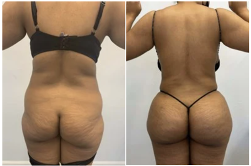 Brazilian Butt Lift - Jubilee Cosmetic Surgery provides a variety of body contouring and skin rejuvenation procedures utilizing a personalized approach to patient care.
Please call today to schedule a Consultation, Peach Perfection Awaits! Brazilian Butt Lift - Jubilee Cosmetic Surgery provides a variety of body contouring and skin rejuvenation procedures utilizing a personalized approach to patient care.
Please call today to schedule a Consultation, Peach Perfection Awaits!