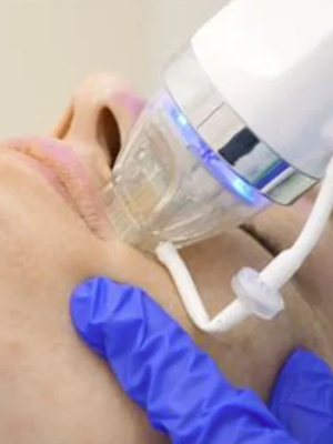 Microneedling - RF Microneedling (Radio Frequency Microneedling), does all that standard microneedling does, but AMPLIFIES the outcome. Great for skin laxity, enlarged pores, fine lines/wrinkles, uneven skin tone & texture, acne scars, stretch marks, hyperpigmentation/melasma/sun damage. You will start to see results right away and they will continue for months.
Microneedling, also called collagen induction therapy, involves the use of many small needles to puncture the skin.