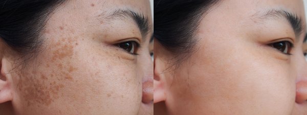 RF microneedling, also called Collagen Induction Therapy is the newest technology with very little down time. - These procedures enhance, repair and restore beauty. Micropigmentation works wonders for enhancing natural beauty.