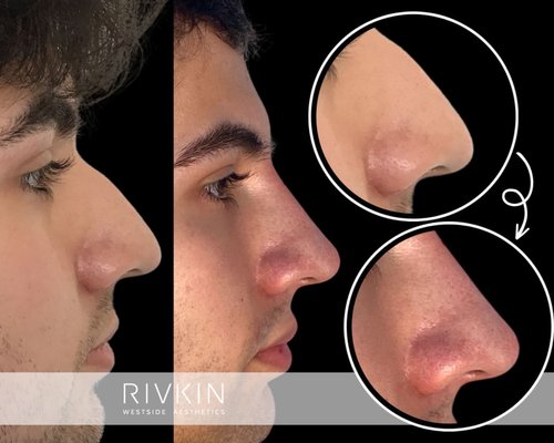 Non Surgical Nose Job - Non-Surgical Nose Job: A quick 5-minute non-invasive, non-surgical procedure. Using dermal filler to correct and balance out the nose features. This treatment gives patients a straighter, better defined, symmetric and proportional nose at a fraction of the cost of surgical rhinoplasty.
The Non-Surgical Rhinoplasty is safer than the surgical option and requires zero down-time. Non Surgical Nose Job - Non-Surgical Nose Job: A quick 5-minute non-invasive, non-surgical procedure. Using dermal filler to correct and balance out the nose features. This treatment gives patients a straighter, better defined, symmetric and proportional nose at a fraction of the cost of surgical rhinoplasty.
The Non-Surgical Rhinoplasty is safer than the surgical option and requires zero down-time.