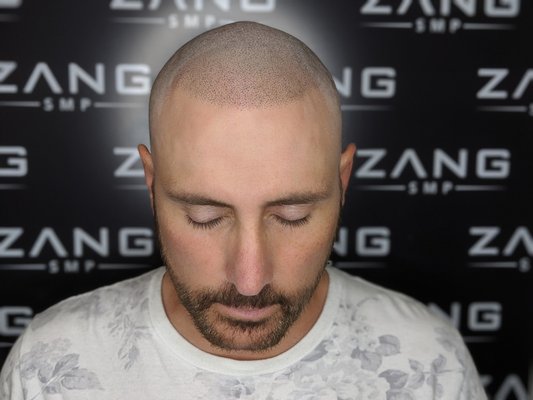 David's first session of Micropigmentation. - David was suffering from hair loss where we he was not a good candidate for hair transplant. After doing extensive research he discovered from his hair transplant doctor that this solution was probably his best bet. After doing a consultation and meeting with the staff he buzzed his head down, pulled the trigger and made the decision of getting the SMP done. Best part, wife approved. David's first session of Micropigmentation. - David was suffering from hair loss where we he was not a good candidate for hair transplant. After doing extensive research he discovered from his hair transplant doctor that this solution was probably his best bet. After doing a consultation and meeting with the staff he buzzed his head down, pulled the trigger and made the decision of getting the SMP done. Best part, wife approved.