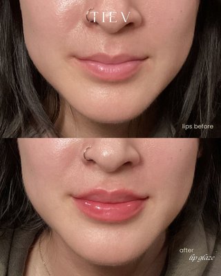 Lip Filler - LIP FILLER! Bring balance back to the face starting with LIPS! One syringe of hyaluronic acid filler to the lips for a soft, balanced look. Lip Filler - LIP FILLER! Bring balance back to the face starting with LIPS! One syringe of hyaluronic acid filler to the lips for a soft, balanced look.