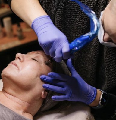 Microneedling - Microneedling