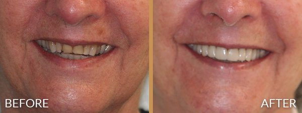 Cosmetic Dentistry & Smile Makeovers - Welcome to the Northridge Dental Group Cosmetic Dentistry portfolio! Your smile is often the first thing people notice, and our goal is to ensure it leaves a lasting, confident impression. For over 50 years, our dedicated cosmetic specialists—including Dr. Shahdad Arami, Dr. Isaac Rezvani, and Dr. Amirali Entezam—have combined dental science with artistic precision to craft beautiful, natural-looking smiles for our San Fernando Valley patients.
Every smile is unique, which is why we don't believe in a one-size-fits-all approach. Whether you are looking for a subtle enhancement or a complete aesthetic transformation, our multi-specialty team works closely with you to design a personalized "Smile Makeover" treatment plan that complements your facial features and meets your goals.
Inside this portfolio, you will see stunning before-and-after transformations featuring our premier cosmetic services:
Porcelain Veneers: See how we use ultra-thin, custom-crafted porcelain shells to instantly correct chips, gaps, severe discoloration, and slight misalignments for a flawless, Hollywood-ready smile.
Professional Teeth Whitening: View the dramatic, radiant results of our clinical-strength whitening treatments that safely erase years of coffee, tea, and tobacco stains.
Dental Bonding: Look at our seamless, tooth-colored composite resin repairs that beautifully restore the shape and color of cracked or worn teeth in just one visit.
Complete Smile Makeovers: Browse comprehensive cases where we combined multiple cosmetic and restorative treatments to completely revitalize a patient's smile and confidence.
We invite you to browse our gallery to see the artistry and attention to detail that sets Northridge Dental Group apart. Ready to achieve the smile of your dreams? Contact us today to schedule your complimentary cosmetic consultation! Cosmetic Dentistry & Smile Makeovers - Welcome to the Northridge Dental Group Cosmetic Dentistry portfolio! Your smile is often the first thing people notice, and our goal is to ensure it leaves a lasting, confident impression. For over 50 years, our dedicated cosmetic specialists—including Dr. Shahdad Arami, Dr. Isaac Rezvani, and Dr. Amirali Entezam—have combined dental science with artistic precision to craft beautiful, natural-looking smiles for our San Fernando Valley patients.
Every smile is unique, which is why we don't believe in a one-size-fits-all approach. Whether you are looking for a subtle enhancement or a complete aesthetic transformation, our multi-specialty team works closely with you to design a personalized "Smile Makeover" treatment plan that complements your facial features and meets your goals.
Inside this portfolio, you will see stunning before-and-after transformations featuring our premier cosmetic services:
Porcelain Veneers: See how we use ultra-thin, custom-crafted porcelain shells to instantly correct chips, gaps, severe discoloration, and slight misalignments for a flawless, Hollywood-ready smile.
Professional Teeth Whitening: View the dramatic, radiant results of our clinical-strength whitening treatments that safely erase years of coffee, tea, and tobacco stains.
Dental Bonding: Look at our seamless, tooth-colored composite resin repairs that beautifully restore the shape and color of cracked or worn teeth in just one visit.
Complete Smile Makeovers: Browse comprehensive cases where we combined multiple cosmetic and restorative treatments to completely revitalize a patient's smile and confidence.
We invite you to browse our gallery to see the artistry and attention to detail that sets Northridge Dental Group apart. Ready to achieve the smile of your dreams? Contact us today to schedule your complimentary cosmetic consultation!