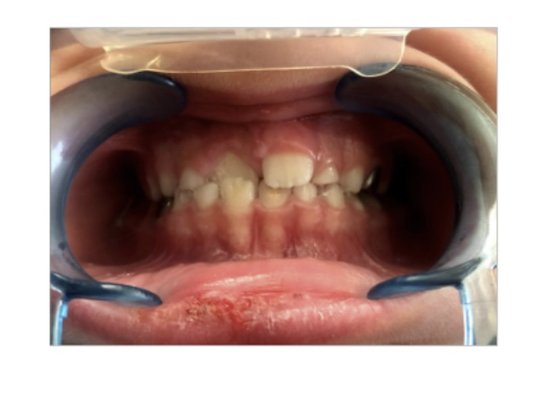 Interceptive orthodontic treatment - At The Wiggly Tooth we offer limited orthodontic treatment nitrous, oral sedation and in-office Interceptive orthodontic treatment - At The Wiggly Tooth we offer limited orthodontic treatment nitrous, oral sedation and in-office