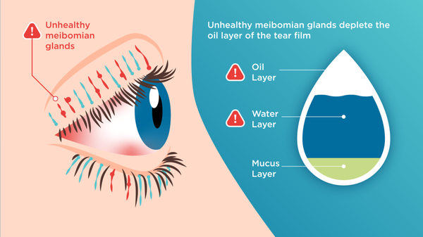 Dry Eye Treatment - We strive to treat Dry eye with the best available treatments. Every person gets a unique dry eye plan that fits their particular needs. We have state of the art dry eye treatments available.