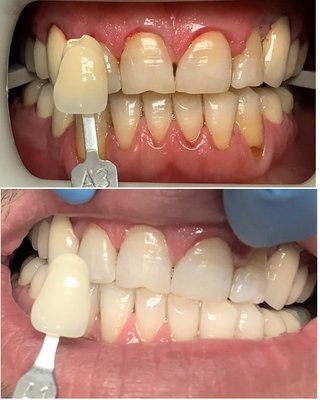 Whitening - This is only after 15 minutes of whitening. Can go for a full hour if you want a whiter smile. Whitening - This is only after 15 minutes of whitening. Can go for a full hour if you want a whiter smile.
