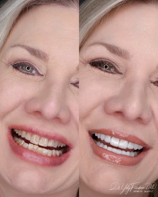 Smile Makeover 20 Teeth | Translucent Porcelain Veneers - Happy Patient | New Smile with Translucent Porcelain Veneers 🦷🔥🦷🔥🦷🔥 by Dr. FUNDORA @wholedentaldesign - ⭐ We do not Paint the Translucency ⭐ Ask your Dentist if they Do?? We installed 20 porcelain veneers, with beautiful anatomical details, translucency, many natural effects and proportions much more in line with her smile without a doubt a beautiful change. Smile Makeover 20 Teeth | Translucent Porcelain Veneers - Happy Patient | New Smile with Translucent Porcelain Veneers 🦷🔥🦷🔥🦷🔥 by Dr. FUNDORA @wholedentaldesign - ⭐ We do not Paint the Translucency ⭐ Ask your Dentist if they Do?? We installed 20 porcelain veneers, with beautiful anatomical details, translucency, many natural effects and proportions much more in line with her smile without a doubt a beautiful change.