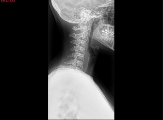 Chiropractic Care 2021 - This patient came to our office suffering from chronic headaches and low back pain. The before photo represents how the structure of the spine was prior to care. We know that as structures suffer, so does the function. The after photo is a month into care! The patient is now doing tremendously better and able to see progression with their health! Chiropractic Care 2021 - This patient came to our office suffering from chronic headaches and low back pain. The before photo represents how the structure of the spine was prior to care. We know that as structures suffer, so does the function. The after photo is a month into care! The patient is now doing tremendously better and able to see progression with their health!
